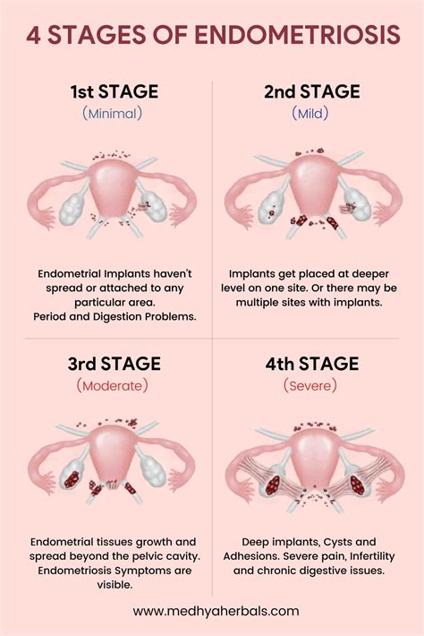 what are the 4 stages of endometriosis